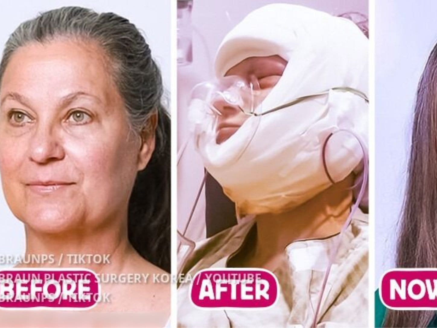 “Mom Transformed Into the Daughter!” A Woman Won a Makeover at a Korean Clinic, and People Are in Awe of Her Beauty||||||