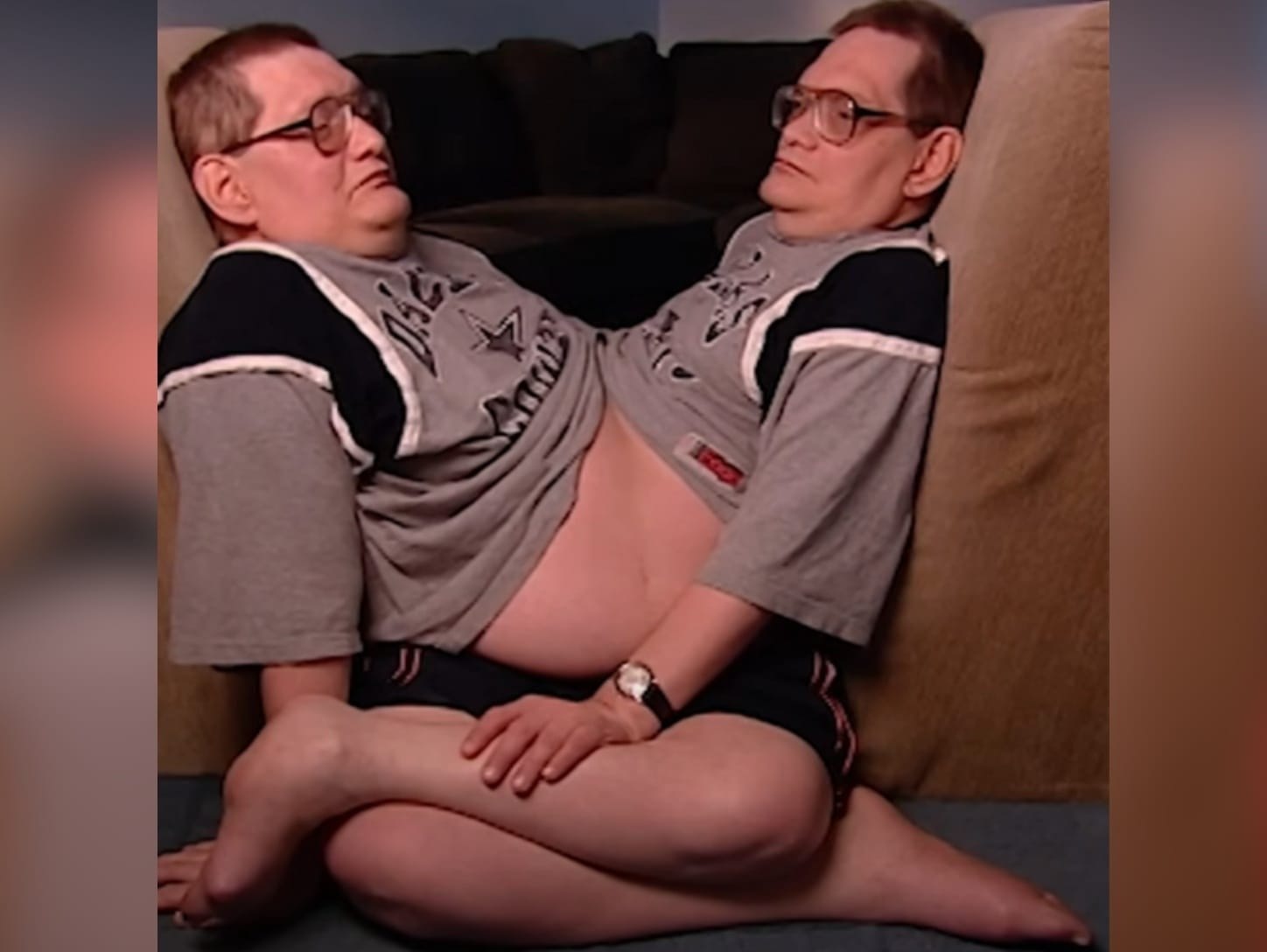 Oldest Ever Conjoined Twins Had Incredible Response When Asked If They Would Have Wanted To Be Separated|||