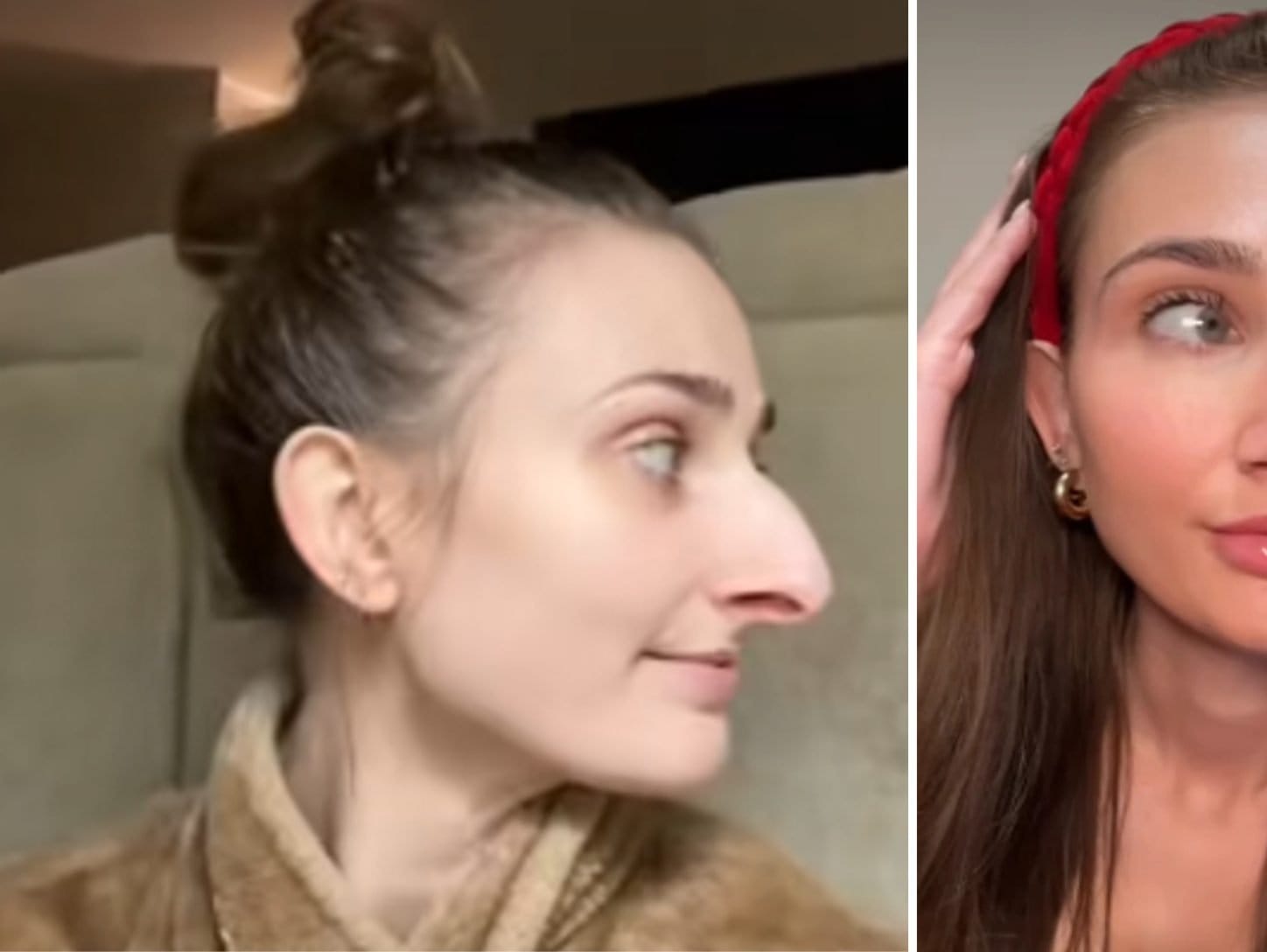 She Revealed Her Plastic Surgery Results And Everyone’s Jaw Dropped|||||