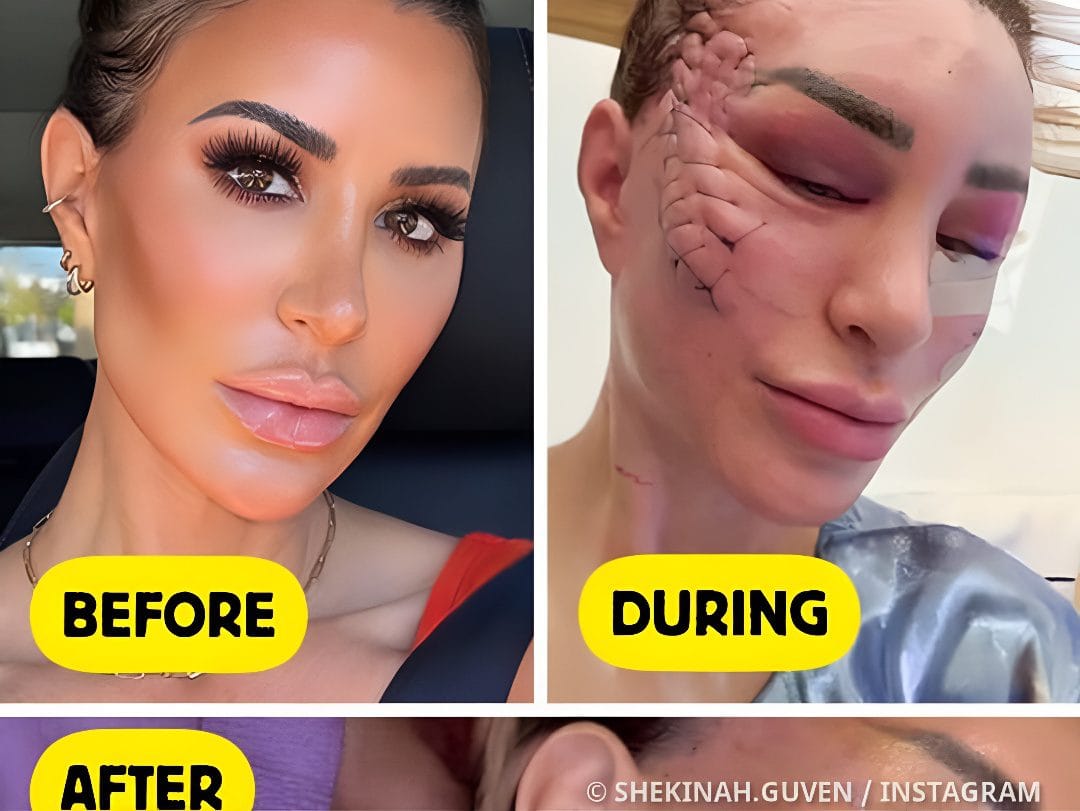 This Woman’s Facelift Transformation Has Everyone Speechless||||||