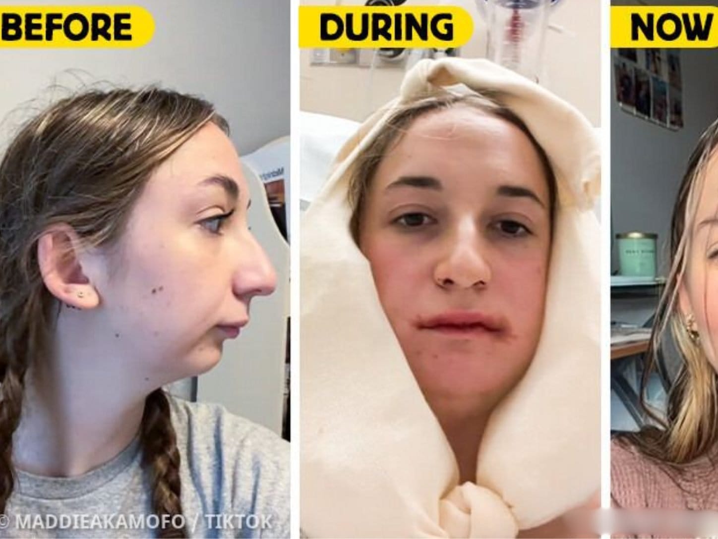 Young Woman Reveals Dramatic Results of Her Jaw Surgery, Leaving People Stunned||||||