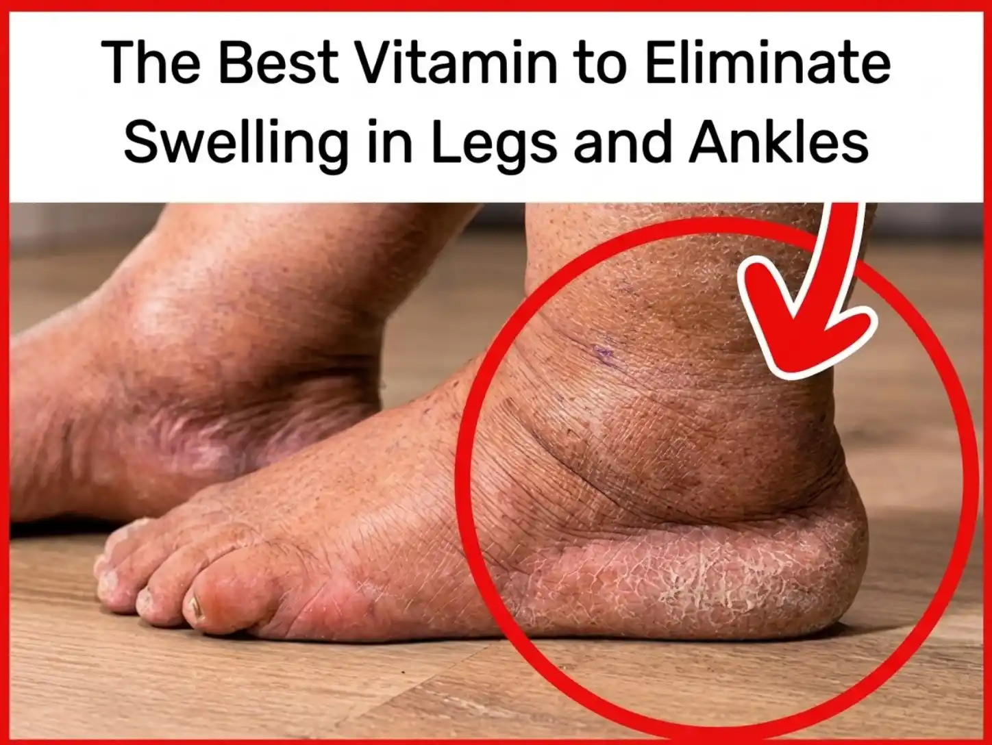 The Best Vitamin for Swollen Legs and Ankles What You Should Know